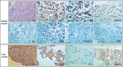 Figure 2. Histopathological findings in metastatic bladder and primary lung adenocarcinoma samples. In bladder sample (upper) and lung sample (under), the adenocarcinoma is visible with hematoxylin and eosin staining. Both samples immunohistochemical stains demonstrate the same positive for cytokeratin-7, TTF-1 and napsin A; negative P63, CK20, Uroplakin-II and GATA staining in bladder sample. Original magnification, ×100