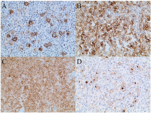 Figure 1. Immunohistochemical staining of CD30 in PTLD after solid organ transplantation. (A) Polymorphic PTLD with approximately 10% CD30+ cells. (B) Diffuse large B-cell lymphoma, non-germinal center type, with approximately 80% CD30+ tumor cells. (C) Anaplastic large cell lymphoma with 100% CD30+ tumor cells D) Hodgkin lymphoma-like PTLD with 100% CD30+ Hodgkin and Reed/Sternberg (HRS) cells.