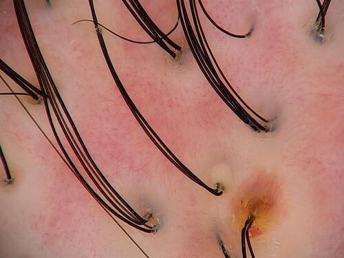 Figure 3 Trichoscopy showing follicular tufts, pustules and dilated blood vessels in an area of scarring alopecia.