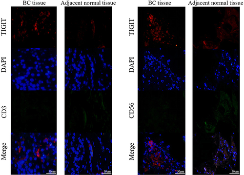 Figure 4 Representative immunofluorescence microscopic images of TIGIT, CD3, and CD56 in BC tissues and adjacent tissues.