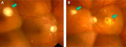 Figure 1 Fundus photographs obtained at the initial examination.