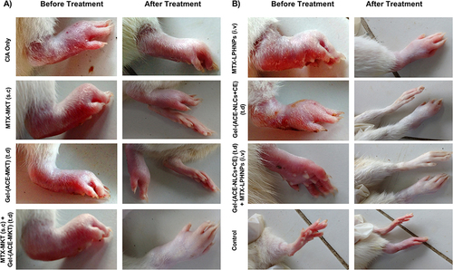 Figure 7 The therapeutic efficacy of “Mono” and “Combination” drug regimen in the rats with the experimental RA. The CIA served as a positive control and untouched controls were taken as the healthy/experimental control. (A) MTX-MKT (s.c.), Gel-(ACE-MKT) (t.d.) and combination of these formulations were administered to the experimental animals, (B) mono (MTX-LPHNPs (i.v.), Gel-(ACE-NLCs+CE) t.d.) and combination [MTX-LPHNPs (i.v.) and Gel-(ACE-NLCs+CE) t.d.)] drug therapy via the intravenous and transdermal route saw a significantly higher reduction of the inflammation induced by the RA. The experimental animals regained the paw structure similar to those with the untouched healthy control.