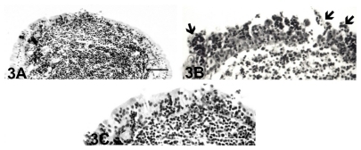 Figure 3 Light micrographs of nodular lymphoid tissue in the inflamed lacrimal sac at 1 month (A) and (B) and 3 months (C) after Staphylococcus aureus inoculation. (A) One month after bacterial inoculation, the nodular lymphoid tissue had numerous lymphocytes, and many were infiltrated into the follicle-associated epithelium. Bar = 60 μm. (B) There was infiltration of the inflammatory cells and desquamation of the degenerated epithelial cells (arrows) that covered the follicle. Bar = 40 μm. (C) At 3 months, the follicle-associated epithelium was intact, but the epithelial infiltration of the lymphocytes decreased. Bar = 40 μm.