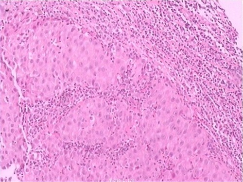 Figure 2 Image of core needle biopsy histologic diagnosis using hematoxylin and eosin staining (original ×100).