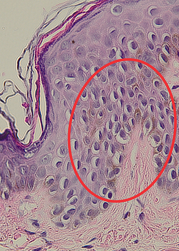 Figure 2 Histopathological features of a punch biopsy of the hyperpigmented macule on the right cheek showed an increase in melanin pigmentation in the basal layer of the epidermis (red circle).