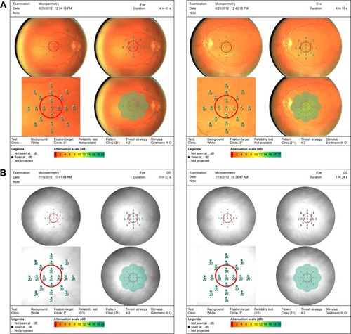 Figure 9 Pre- and post-microperimtery fields on two patients.