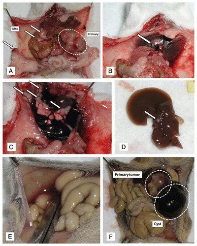 Figure 6 Macroscopic images of metastatic pancreatic cancers arising in CBP mice. (A) A primary pancreatic cancer (white dotted line) and numerous grossly visible metastatic lesions (white arrows) to distant organ sites, including peritoneum, diaphragm (B), lungs (C) and liver (D). At these advanced stages, malignant ascites was observed in some of the affected mice (E). In addition, some animals developed hemorrhagic intra-pancreatic cystic lesions, likely due to bleeding (F).