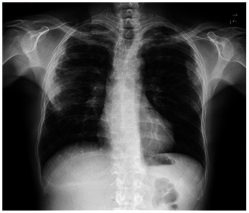 Figure 1 Chest x-ray: bilateral pulmonary opacities.