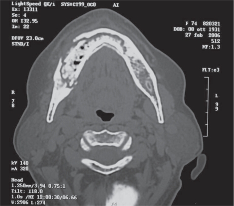 Figure 4 Computed tomographic scan of the bone sequestrum in patient treated with Zometa® for 5 months (75 years old, female, breast cancer).