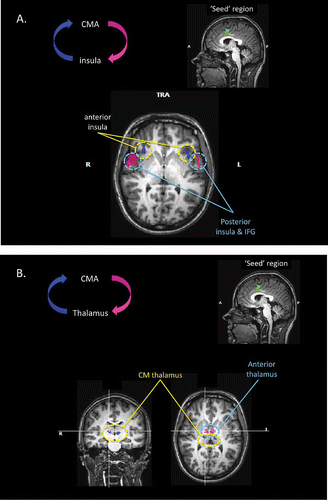 Figure 6. (A) Results of the effective connectivity analyses, based upon Granger causality mapping (GCM), of the yawning fMRI study. In this case, the “seed” region for the GCM has been defined as the region of the mid-cingulate cortex significantly activated during the urge to yawn. The GCM analysis revealed that regions of the anterior insula bilaterally exert a significant influence over the seed region (blue), whereas regions of the mid-insula and inferior frontal lobe bilaterally are influenced by the seed area (pink). TRA: transverse; IFG: inferior frontal gyrus. (B) Further results of the GCM analysis based upon the mid-cingulate “seed” region. The analysis also revealed that regions of the centromedial thalamus bilaterally exert a significant influence over the seed region (blue), and bilateral regions of the anterior thalamus are influenced by the seed area (pink). CMA: cingulate motor area.