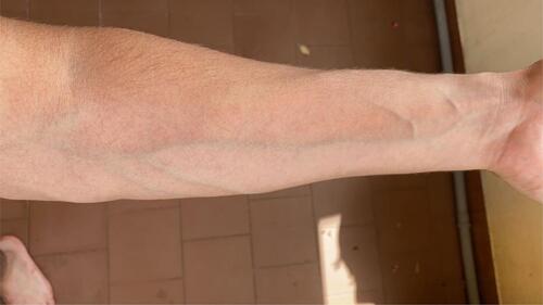 Figure 2 Absence of lesions in left arm after exercise test during therapy with Dupilumab.
