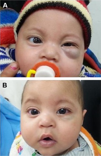 Figure 2 Infant, 2 months of age, with left-eye hemangioma.