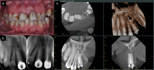 Figure 1. (a) Pre-operative clinical photograph; (b) Pre-operative radiographs; (c) CBCT showing concrescence of teeth #7 and 8.