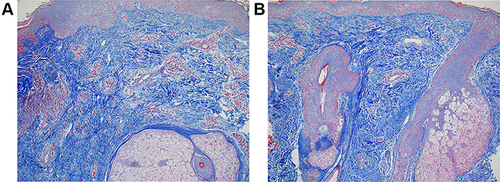 Figure 9 (A and B) Trichrome stain in subject using RSN shows day 0 shows focally abnormally thin collagen bundles (A) while day 90 shows a modest increase in normal-density collagen bundles (B).