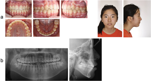 Figure 6. Debonding: Intraoral and facial photographs (a), panoramic radiograph and lateral cephalogram (b).