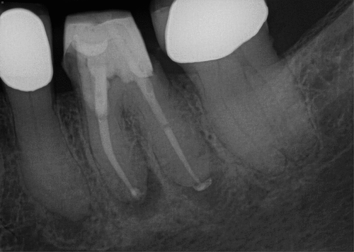 Figure 39. Post op 2 radiograph showing a different view of final outcome.