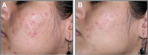 Figure 2 Photographic evaluation of Farmaka Acne Cream in volunteer 27.