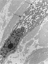 Figure 4 Fibroblasts with numerous dilated rough endoplasmic reticulum cisternae (arrows), × 3600.