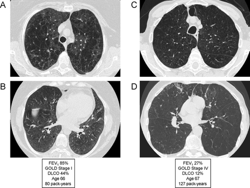 Figure 16 Variable degree of airflow limitation (FEV1) with similar emphysema severity. (A) and (B) are from the same patient, and demonstrate severe panlobular and centrilobular upper lobe emphysema (A), with a predominant centrilobular pattern in the lower lobes (B) but a preserved FEV1. (C) and (D) are from a different patient with a comparable pattern of diffuse upper and lower lobe emphysema. Although there is only slightly worse lower lobe emphysema (D) in the second patient, there is much more severe airflow limitation and loss of DLCO.