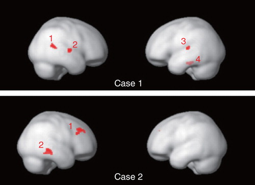 Figure 3. Cortical activation by language-related visual stimuli in the two profoundly deafened cases. Case 1 (GJB2 mutation) showed significant activation in the right middle temporal gyrus [BA21] (1), superior temporal gyrus [BA22] (2), and left superior temporal gyrus [BA42] (3), and left cerebellum (4), while case 2 (SLC26A4 mutation) exhibited significant activation in the right superior frontal gyrus [BA9] (1), and middle temporal gyrus [BA20] (2) (SPM2, p < 0.001, uncorrected).