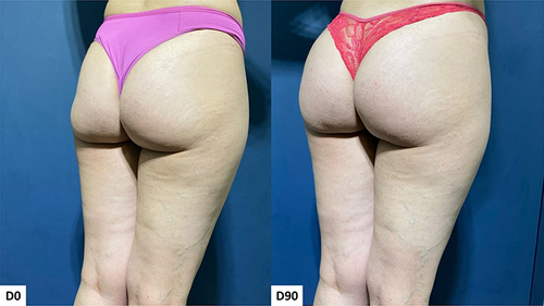Figure 10 Case 5, Buttocks Beautification 3D. Standardized oblique images pre and 90 days post injection.
