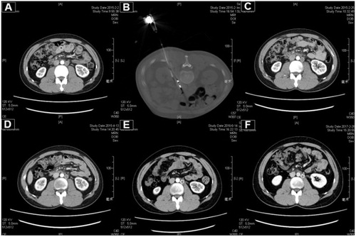 Figure 2. A 27-year-old male patient with testicular embryonal carcinoma and peritoneal metastasis was treated with MWA. (A) The enhanced CT pre-ablation. (B) The procedure of ablation. (C) One month post-ablation. (D) Three months post-ablation. (E) Sixteen months post-ablation. (F) Twenty-four months post-ablation.