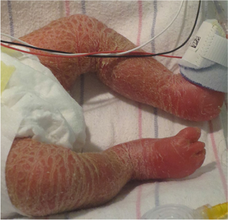 Figure 1 Infant with a metabolic disorder, widespread hyperkeratotic scale, but no collodion is present.
