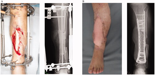 Figure 3. Case 1: (A) Preoperative clinical and radiographic findings. (B) Postoperative findings at 1 year.