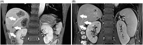 Figure 6. A 64-year-old male patient with CRLM. (A) CEMRI showed colorectal metastases in the liver (thick arrow). (B) after induction chemotherapy, CEMRI demonstrating no lesion at the site of metastases on the prior exam (thick arrow).