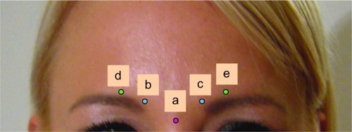 Figure 3 Injection sites.