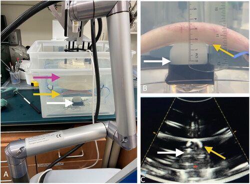 Figure 2. Experimental setup. A) the treatment head (pink arrow) of a clinical-grade histotripsy system was positioned in a degassed water bath above an agar phantom (white arrows) with gas-filled small bowel (yellow arrows) partially blocking the therapeutic beam path. B) Bowel was positioned 0 cm above the phantom (white arrow), shown in the sagittal plane. C) An image from the co-axially mounted diagnostic ultrasound transducer shows the bowel (yellow arrow) positioned above the phantom (white arrow) in the axial plane, which has been obscured by the intraluminal gas.
