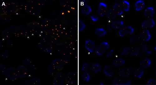 Figure 5 Signal patterns in lung tumor nuclei hybridized with ALK break-apart FISH. (A) A cell is interpreted as having a normal pattern (ALK negative) when the 5ʹ and 3ʹ signals are fused (indicated by arrows); (B) A cell is interpreted as having a split pattern (ALK positive) when the 5ʹ and 3ʹ signals are separated (indicated by arrows), regardless of the number of actual isolated signals.Abbreviation: ALK, anaplastic lymphoma kinase gene.