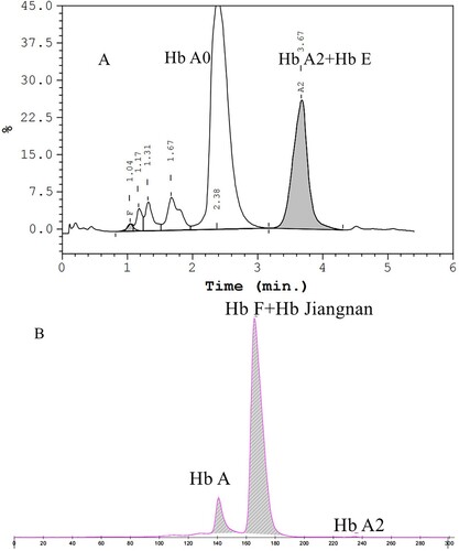 Figure 2. Hb analysis of the proband's wife using HPLC and his baby using CE. HPLC presented a Hb E co-eluted with Hb A2 at retention time 3.67 min in the proband’s wife (A). CE revealed normal results in his baby and there should be a small amount of Hb Jiangnan and Hb F that failed to separate (B).