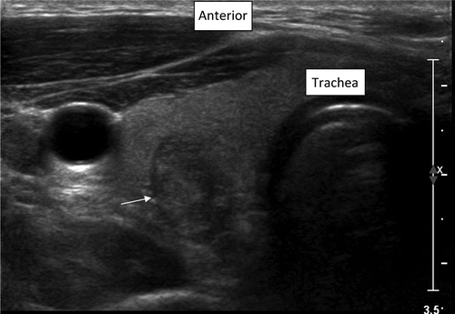 Figure 1. Thyroid ultrasound showing microcalcifications, poorly defined borders, and taller than wider shape.