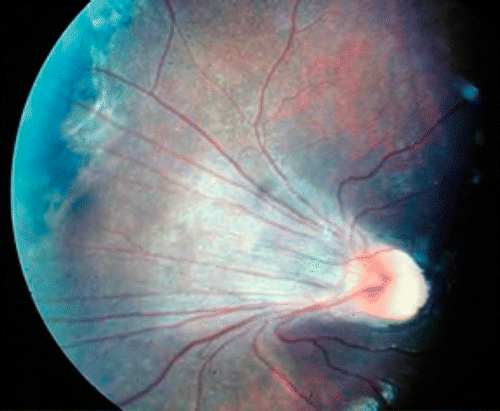 Figure 8: Dragged macula as a result of scarring following retinopathy of prematurity