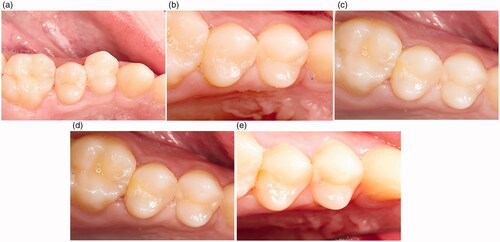 Figure 2. (a) Tooth 15 MOD (SBU/FZXT) preoperative. (b) Tooth 15 MOD (SBU/FZXT) at Baseline. (c) Tooth 15 MOD (SBU/FZXT) at 6 months. (d) Tooth 15 MOD (SBU/FZXT) at 12 months. (e) Tooth 15 MOD (SBU/FZXT) at 36 months.