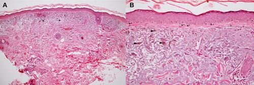 Figure 2 Histopathologic change in the dermis of lesional melasma. (A) Melanin deposition in the epidermis and solar elastosis in the dermis (arrow) (Hematoxylin and Eosin, HEx100) (B) pendulous melanocytes in the basal layer of epidermis (arrow) and increased dermal melanophages (arrowhead) (HE x400).