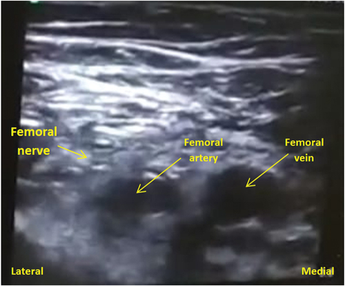Figure 1. Ultrasound view of the femoral neuro vascular bundle.