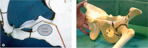 Figure 6. The pubic, ichial and iliac osteotomy viewed from the inside of the pelvis and seen from the outside. Note that the posterior column remains intact.