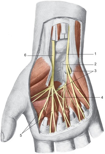 Figure 2 Location of the median and ulnar nerves in the region of the palm.Notes: 1: The ulnar nerve; 2: the transverse carpal ligament; 3: deep palmar branch of the hand; 4: anastomosis between the median nerve and ulnar nerve; 5: digital nerves; 6: the median nerve. Reproduced with permission from Anastasi et al. AA VV, Anatomia dell’Uomo [Human Anatomy]. 4th ed. Milan: Edi. Ermes. Italian.Citation30 Copyright 2010 Edi. Ermes, Milano.