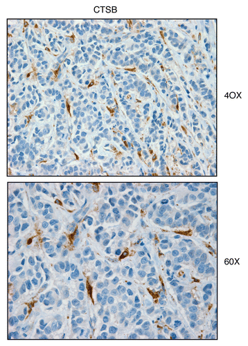 Figure 2 Cathepsin B, a lysosomal protease and autophagy marker, is selectively increased in the stroma of human breast cancers. Paraffin-embedded sections of human breast cancer samples lacking stromal Cav-1 were immuno-stained with antibodies directed against Cathepsin B. Slides were then counter-stained with hematoxylin. Note that Cathepsin B is highly expressed in the stromal compartment of human breast cancers that lack stromal Cav-1. Two representative images are shown. Original magnification, 40x and 60x, as indicated.