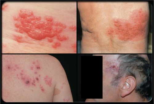 Figure 1 Herpes zoster (shingles) rash.