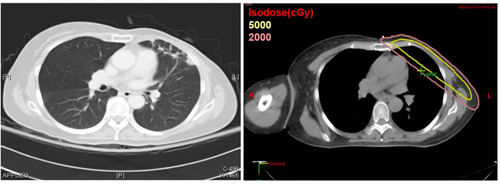 Figure 3 Relationship between RT-induced radiologic changes and V20 of ipsilateral lung Representative pictures of a selected patient with RT-induced radiologic changes and the isodose distribution are shown, respectively (prescribed dose: yellow curve; V20: orange curve).
