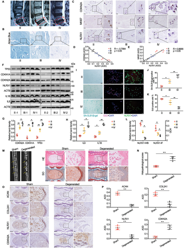 Figure 1. Downregulation of NLRX1 correlates with aggravated human NP cell senescence and IDD progression. Human NP tissue specimens with different degenerative grades were collected for histological analysis. (A) Representative MRI images at T2 weight sequence were evaluated by Pfirrmann grading system. II: grade II, III: grade III, IV: grade IV. (B) histological analysis of human NP samples by alcian blue staining, scale bar: 100 μm. (C) immunohistochemical staining of CDKN2A, MKI67 and NLRX1 in different degenerative NP tissues, scale bar: 100 μm. (D and E) linear regression analyses of the tissue staining intensity of CDKN2A and that of NLRX1 (D), or the intensity of MKI67 and that of NLRX1 (E). AOD, average optical density. (F-H) protein expressions of senescence indicators (TP53, CDKN1A, CDKN2A), SASP factors (IL1B, IL6) and NLRX1 in primary human NP cells isolated from different degenerative NP tissues with the treatment of TBHP (100 μM), as determined by western blotting. (I-L) cell senescence (SA-GLB1/β-gal staining), cell proliferation (EdU incorporation) and NLRX1 expression (immunofluorescent staining) in primary human NP cells isolated from different degenerative NP tissues with the treatment of TBHP (100 μM), scale bar: 100 μm. (M and N) MRI examination, hematoxylin and eosin (HE) and safranin-O (SO) staining in sham or operation-induced degenerated disc of rat, scale bar: 500 μm (left panel), 50 μm (right panel). (O and P) immunohistochemical staining of aggrecan, collagen type II, NLRX1 and CDKN2A in sham or operation-induced degenerated disc of rat, scale bar: 500 μm (left panel), 50 μm (right panel). Data are represented as mean ± SD. *p < 0.05, **p < 0.01.