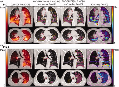 Figure 2. Frontal and transversal planes of (from left to right): AC-CT with Q-SPECT (orange hues), showing values from 0 to maximum counts; 4D-CT with overlay of functional volumes VFL-Q(40%) (orange) and VFL-4D(16%) (light purple), and the overlap between the two (pink); 4D-CT with overlay of functional volumes VFL-Q(1/3) (orange) and VFL-4D(1/3) (light purple), and the overlap between the two volumes (pink); 4D-CT with 4D-CT V-map (rainbow heat map) showing Jacobian values from 1 to maximum value. Primary tumor in red. (a) Patient 2. The cut-off values of 40% for Q-SPECT and 16% for 4D-CT produce volumes of very different size, RFL-Q(40%) is 0.41 and RFL-4D(16%) is 0.12, with OFFL-Q(40%)4D(16%) = 0.70 and IFFL-Q(40%)4D(16%) = 0.09. OFFL-Q(1/3)4D(1/3) is 0.45 and IFFL-Q(1/3)4D(1/3) = 0.10. (b) Patient 20. RFL-Q(40%) is 0.09 and RFL-4D(16%) is 0.13, with OFFL-Q(40%)4D(16%) = 0.37 and IFFL-Q(40%)4D(16%) = 0.03. OFFL-Q(1/3)4D(1/3) = 0.58 and IFFL-Q(1/3)4D(1/3) = 0.15.