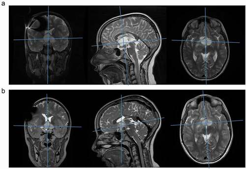 Figure 6. MRI before and after larotrectinib treatment. (a) MR images just before initiation of larotrectinib (February 2019). T2 weighted MR images in (from left to right) coronal, sagittal and axial planes. Blue lines indicate the positions of the other planes, with the main tumor bulk at the intersection. (b) MR images at the most recent follow up, after 14 months of larotrectinib treatment (April 2020). T2 weighted MR images in (from left to right) coronal, sagittal and axial planes. Blue lines indicate the positions of the other planes, with the main tumor bulk at the intersection, showing stable disease (slight size reduction and disappearance of contrast enhancement)