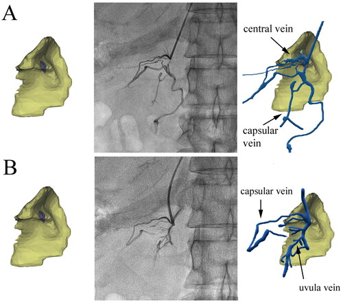 Figure 4. Effect of fusion of the irregular type and 3D model. (A) Adrenal fusion image of a 52-year-old female patient. The distribution of the adrenal veins was disordered, forming an ‘irregular type‘. Brush veins and central veins were shown at the catheter tip. (B) In the same patient, because of the catheter tip bending to the medial gland, more contrast agents entered the uvula vein.