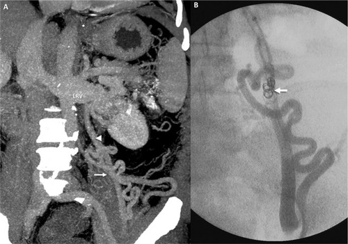 Figure 5 CARTO of mesorenal shunt in a 62-year-old male with refractory HE.