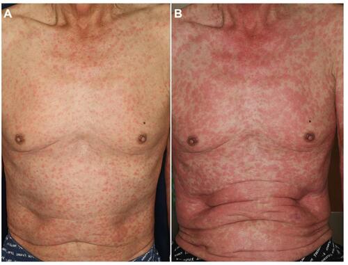 Figure 11 Erythema multiforme-like slight reddish erythemas on the trunk under nivolumab therapy (A), which worsened with targetoid lesions 2 days later (B).