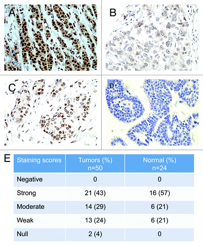 Figure 1. Immunostaining of tumor breast tissues analyzed for RAD50 expression by tissue microarrays. Representative images for RAD50 expression in breast tumors. Immunostaining was defined as (A) high, (B) moderate, (C) weak, and (D) null. Magnification is 400×. (E) Summary of levels of expression of RAD50 in breast carcinomas based on the immunohistochemical scoring described in materials and methods.